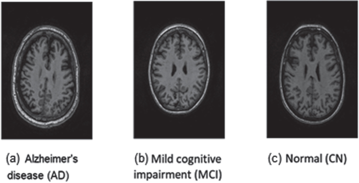 Diagnosis of Alzheimer's Disease and Mild Cognitive Impairment Using Convolutional Neural Networks.