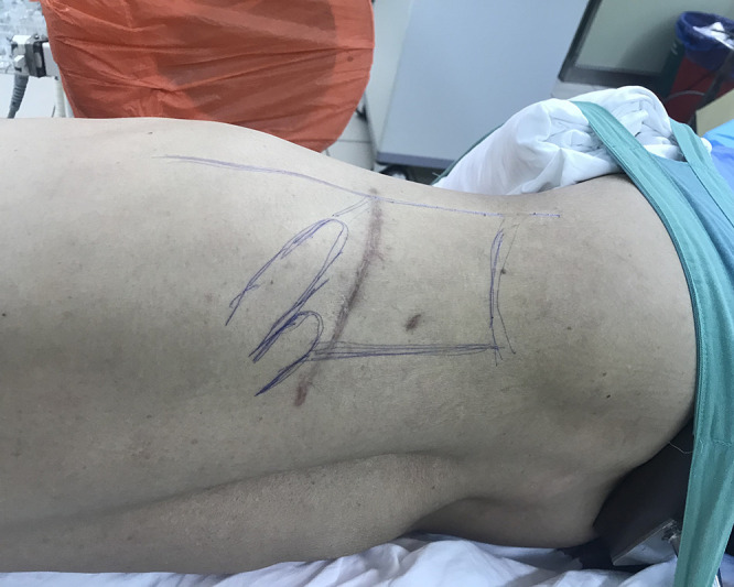 The Outcome of the Miniaturized Percutaneous Nephrolithotomy in Lateral Position with Guidance of Non-Rotational C-Arm.
