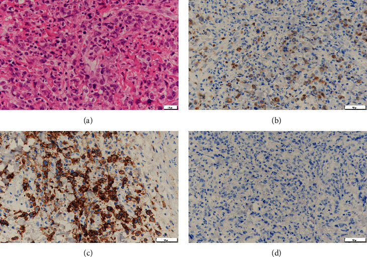 Isolated Central Nervous System Involvement after Brentuximab Vedotin Treatment for HIV-Positive ALK-Negative Anaplastic Large Cell Lymphoma.