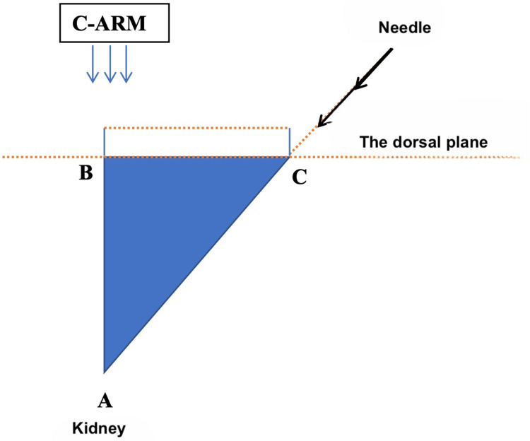The Outcome of the Miniaturized Percutaneous Nephrolithotomy in Lateral Position with Guidance of Non-Rotational C-Arm.
