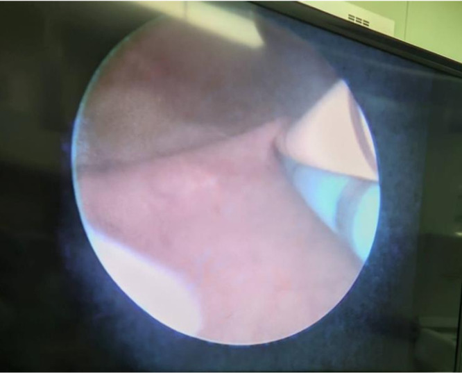 The Outcome of the Miniaturized Percutaneous Nephrolithotomy in Lateral Position with Guidance of Non-Rotational C-Arm.