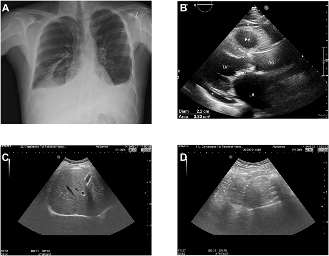 Ascites does not accompany pleural effusion developing under dasatinib therapy in patients with CML-CP.