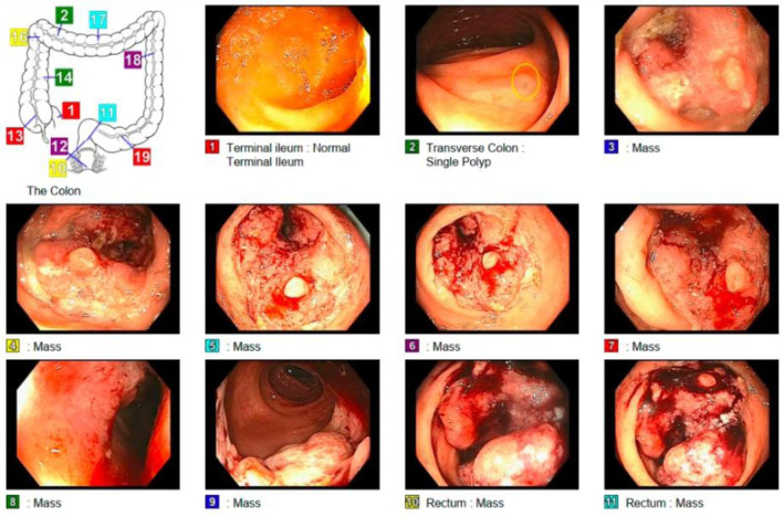 Delays in Colorectal Cancer Screening for Latino Patients: The Role of Immigrant Healthcare in Stemming the Rising Global Incidence of Colorectal Cancer.