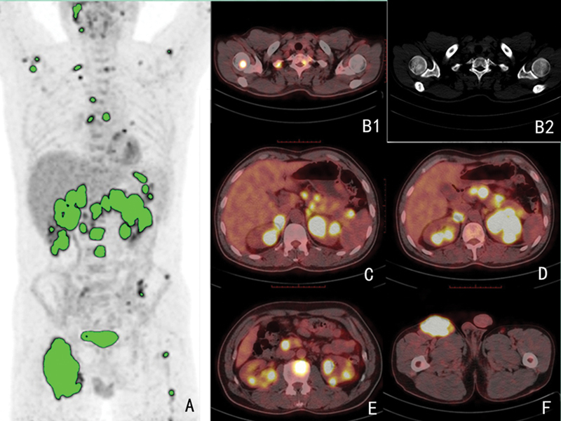 Predictive Value of Corrected <sup>18</sup> F-FDG PET/CT Baseline Parameters for Primary DLBCL Prognosis: A Single-center Study.