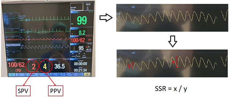 Visual Evaluation of Plethysmographic Waveforms: Introducing the Simple Systolic Ratio as an Indicator of Fluid Responsiveness.
