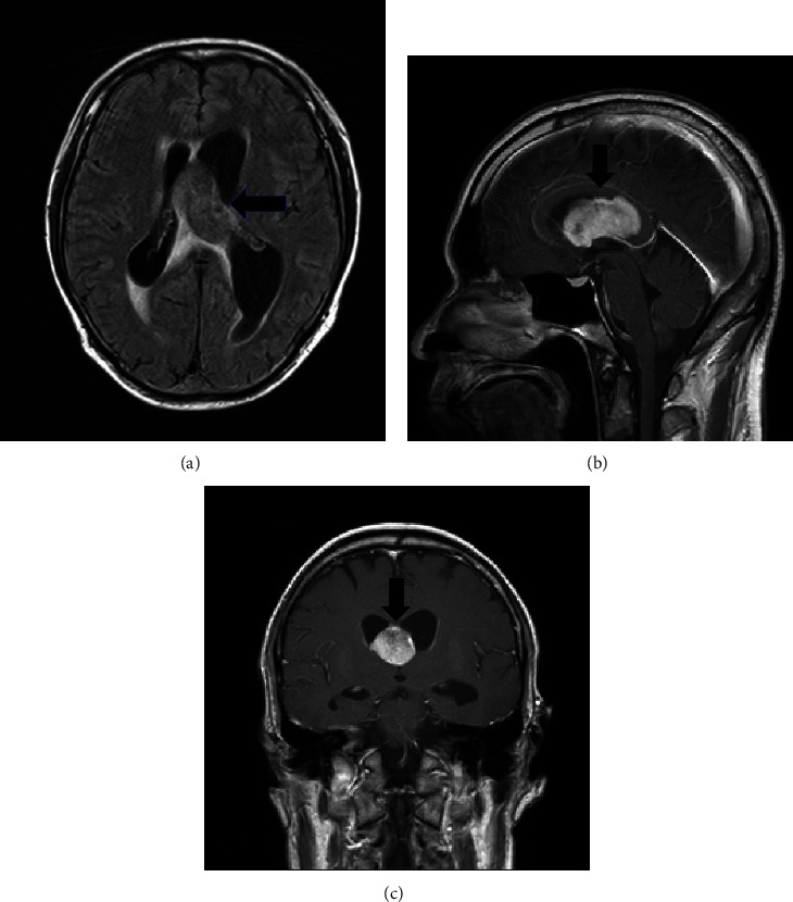 Isolated Central Nervous System Involvement after Brentuximab Vedotin Treatment for HIV-Positive ALK-Negative Anaplastic Large Cell Lymphoma.