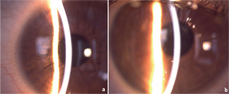 Tubulointerstitial Nephritis and Uveitis Syndrome During the COVID-19 Pandemic: A Case Series.