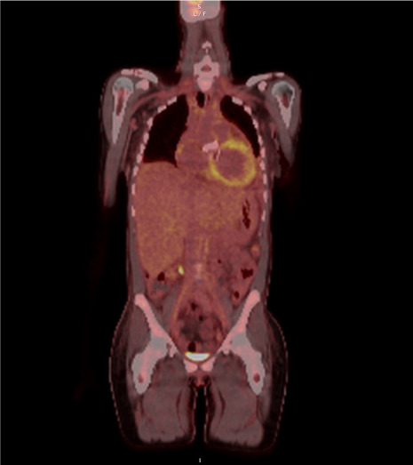 Pericardiectomy and Mechanical Mitro-Aortic Valve Replacement in a Young Patient With Erdheim-Chester Disease.