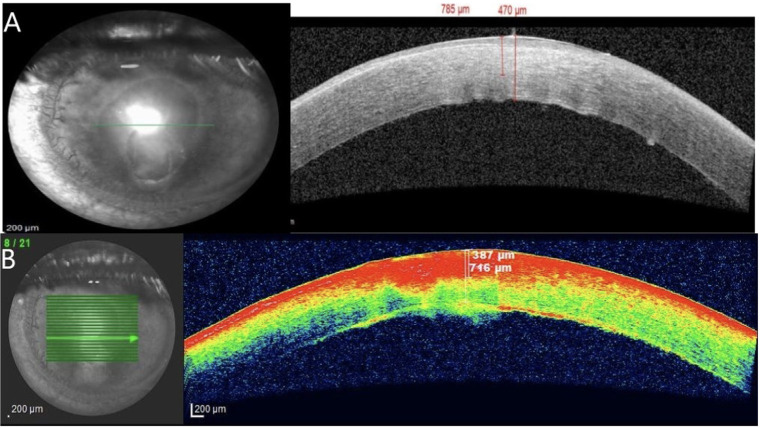 Corneal abscess caused by Filobasidium uniguttulatum. Case report and literature review on cryptococcal keratitis.