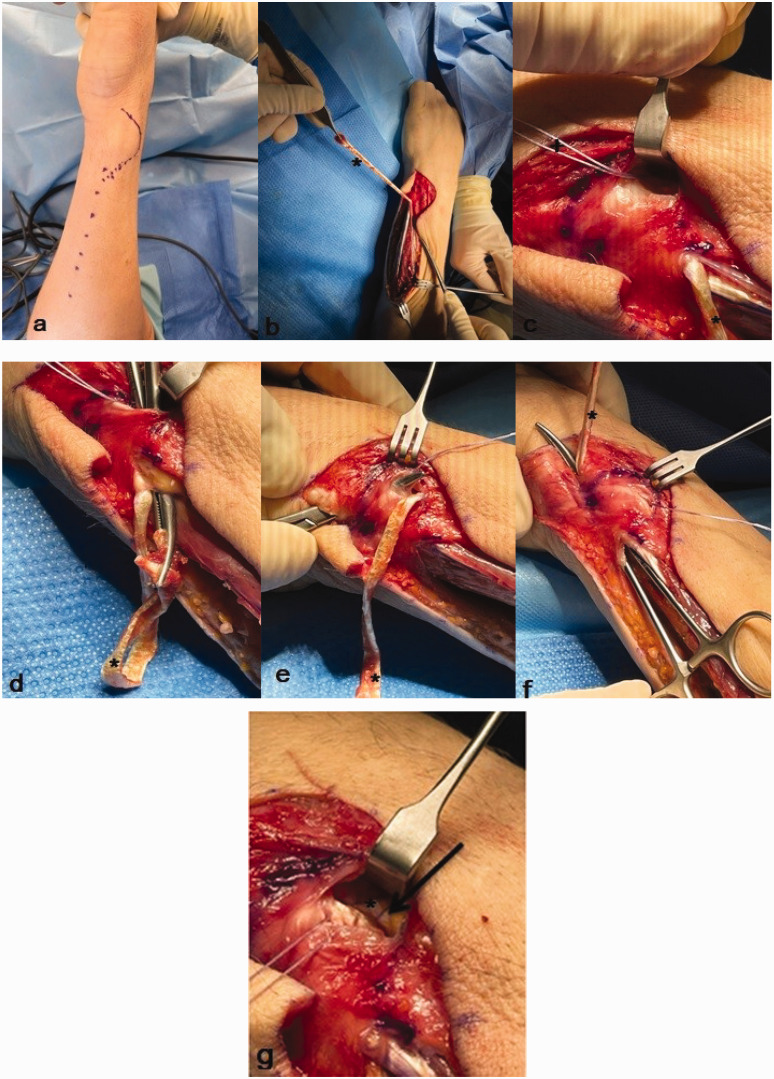 An alternative treatment for degenerative triangular fibrocartilage complex injuries with distal radioulnar joint instability: first experience with 48 patients.