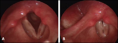 Laryngopharyngeal reflux and idiopathic vocal fold scars.