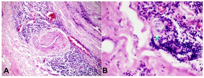 Acute dissection of a syphilitic saccular aneurysm of the ascending aorta and arch in a hypertensive patient - a rare phenomenon.