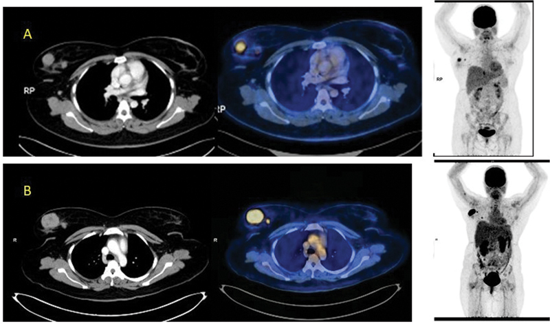 Role of <sup>18</sup> F-FDG-PET/CT in an AML-M5a Subtype Patient with Rare Constellation of Hemophagocytic Lymphohistiocytosis & Bilateral Multiple Breast Chloromas.