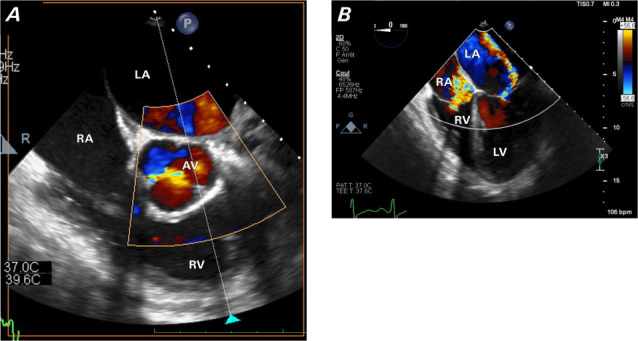 Pericardiectomy and Mechanical Mitro-Aortic Valve Replacement in a Young Patient With Erdheim-Chester Disease.