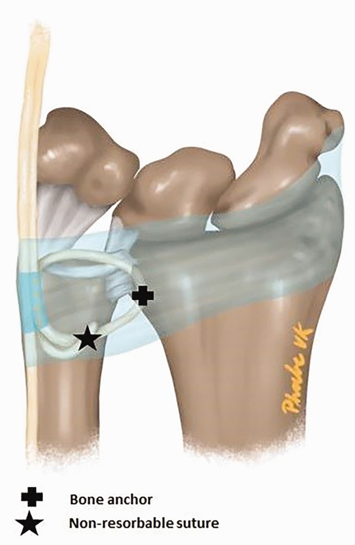 An alternative treatment for degenerative triangular fibrocartilage complex injuries with distal radioulnar joint instability: first experience with 48 patients.