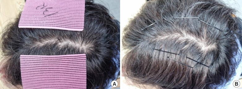 Fixing hair using a hair-fixing sheet: better than hairpins?