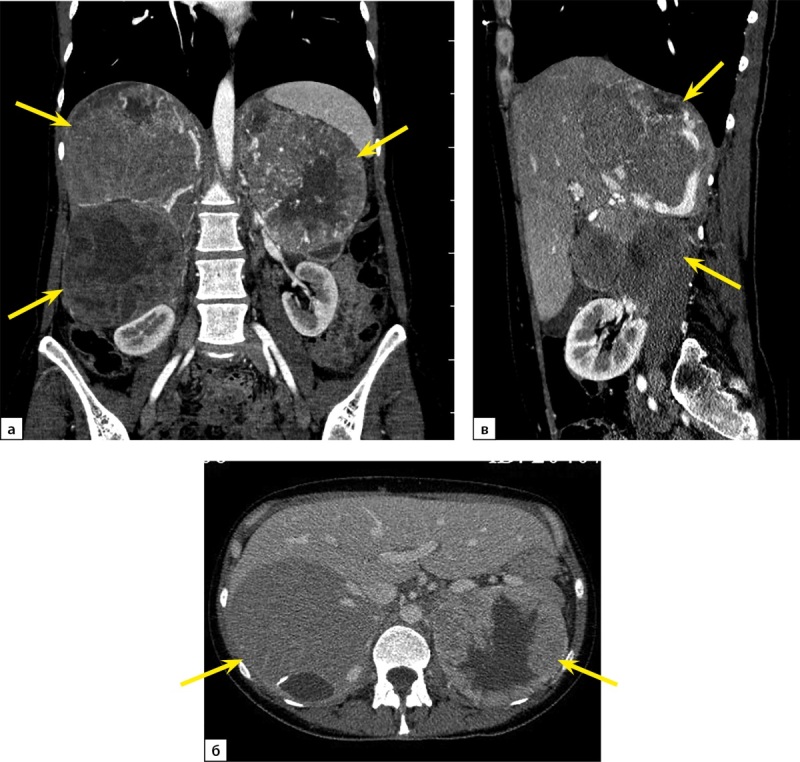 [Metastatic pheochromocytoma in multiple endocrine neoplasia type 2A].