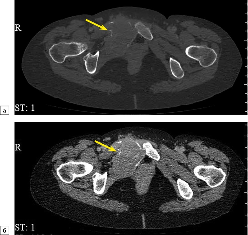 [Metastatic pheochromocytoma in multiple endocrine neoplasia type 2A].
