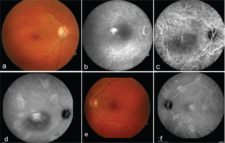 Indocyanine Green Angiography.