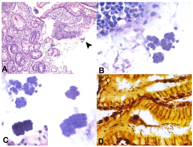 A rare bacterial infection of the gastrointestinal tract: <i>Clostridium ventriculi</i>.