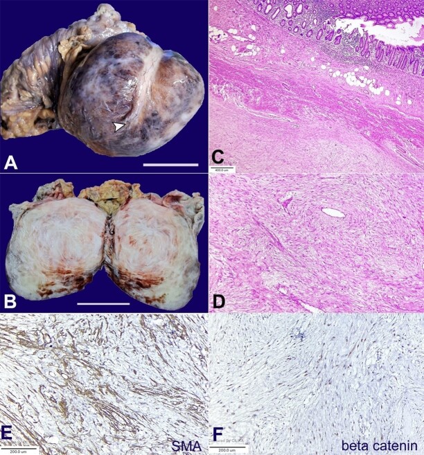 Giant abdominal desmoid-type fibromatosis.