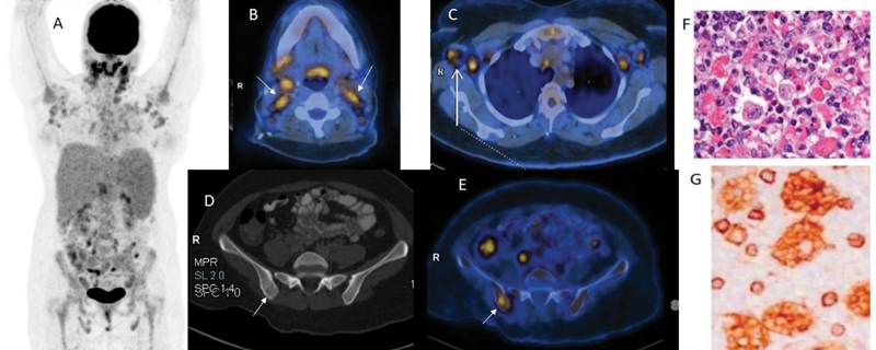 Role of <sup>18</sup> F-FDG-PET/CT in an AML-M5a Subtype Patient with Rare Constellation of Hemophagocytic Lymphohistiocytosis & Bilateral Multiple Breast Chloromas.