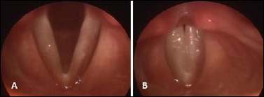 Laryngopharyngeal reflux and idiopathic vocal fold scars.