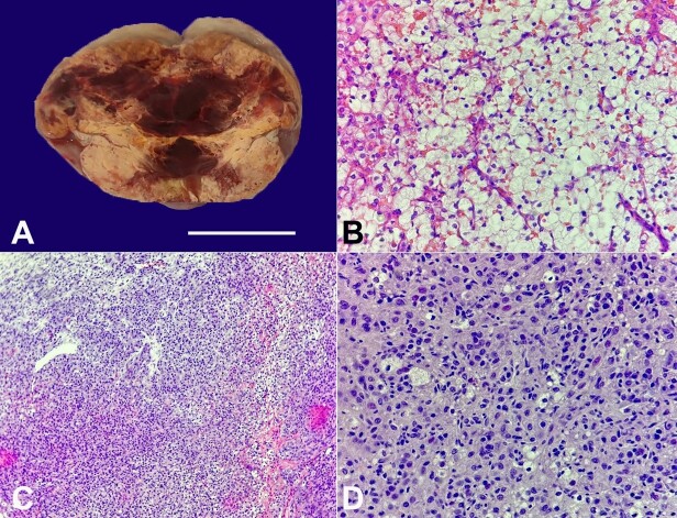 Exploring the unusual: a testosterone-secreting ovarian tumor.