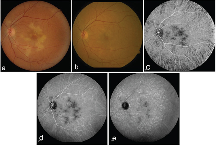 Indocyanine Green Angiography.