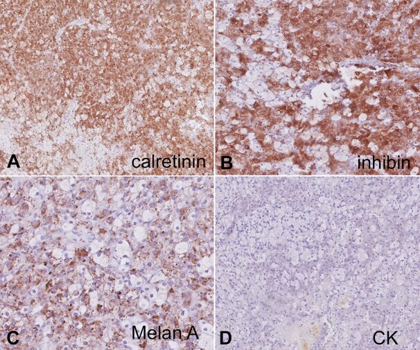 Exploring the unusual: a testosterone-secreting ovarian tumor.