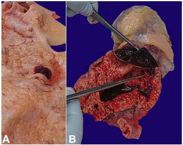 Acute dissection of a syphilitic saccular aneurysm of the ascending aorta and arch in a hypertensive patient - a rare phenomenon.