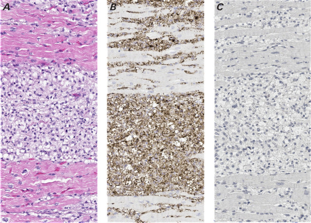Pericardiectomy and Mechanical Mitro-Aortic Valve Replacement in a Young Patient With Erdheim-Chester Disease.