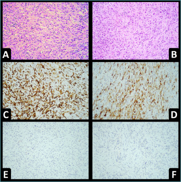 TROP-2, NECTIN-4 and predictive biomarkers in sarcomatoid and rhabdoid bladder urothelial carcinoma.