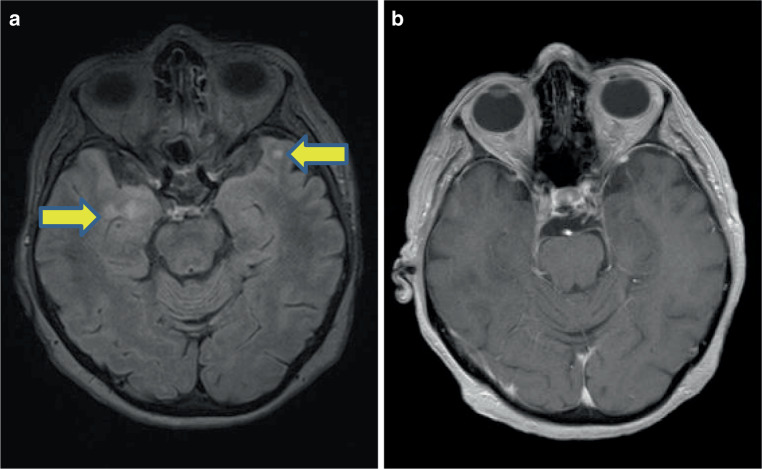 Anti-Ri paraneoplastic neurological syndrome presenting with bilateral cranial nerve VI palsy and jaw dystonia-a distinctive syndrome within the anti-Ri spectrum? : Case report and literature review.