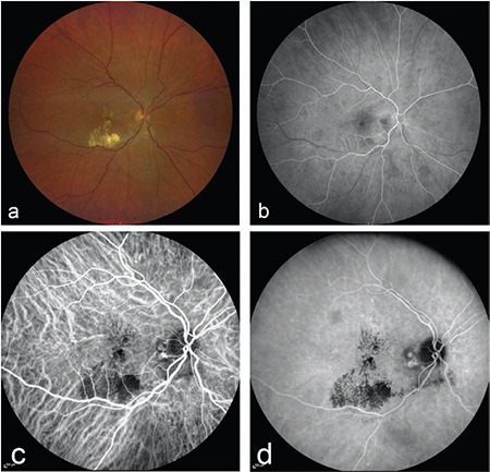Indocyanine Green Angiography.
