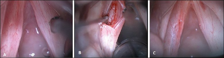 Laryngopharyngeal reflux and idiopathic vocal fold scars.