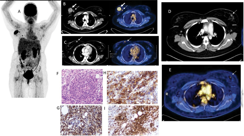 Role of <sup>18</sup> F-FDG-PET/CT in an AML-M5a Subtype Patient with Rare Constellation of Hemophagocytic Lymphohistiocytosis & Bilateral Multiple Breast Chloromas.