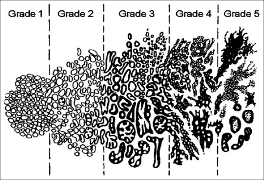 Transfer Learning with Pretrained Convolutional Neural Network for Automated Gleason Grading of Prostate Cancer Tissue Microarrays.