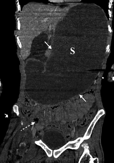 Deadly Aspiration Pneumonia Secondary to Superior Mesenteric Artery Syndrome.
