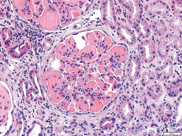 Monoclonal gammopathy of renal significance: An atypical presentation of Waldenström's disease.