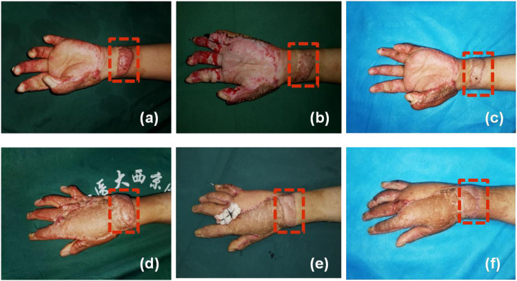 Autologous nanofat harvested from donor site of full-thickness skin or skin flap grafting for the treatment of early postburn scarring: a case series.