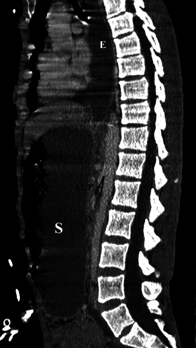 Deadly Aspiration Pneumonia Secondary to Superior Mesenteric Artery Syndrome.