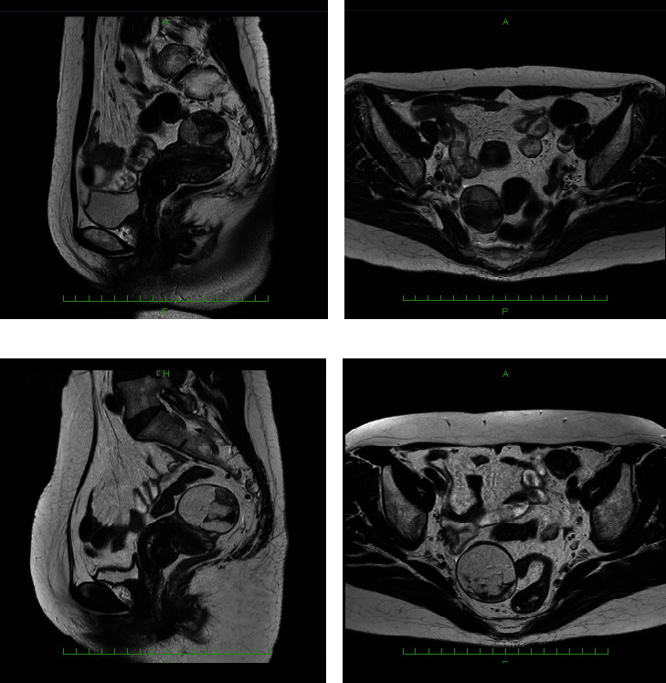 Well-Differentiated Liposarcoma That Increased in Size after Menopause: A Case Report and a Review of the Literature.