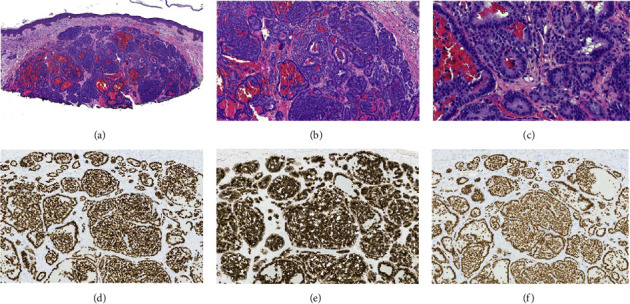 Cutaneous Neuroendocrine Metastases of Visceral Origin Responsive to Surgical Resection and Targeted Radionuclide Therapy.