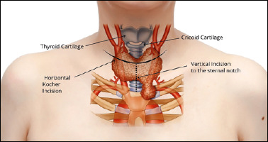 Extended cervical approach for retrosternal multinodular goiter.