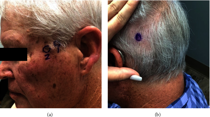 Cutaneous Neuroendocrine Metastases of Visceral Origin Responsive to Surgical Resection and Targeted Radionuclide Therapy.