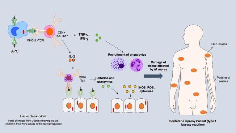 Leprosy reactions: Unraveling immunological mechanisms underlying tissue damage in leprosy patients.