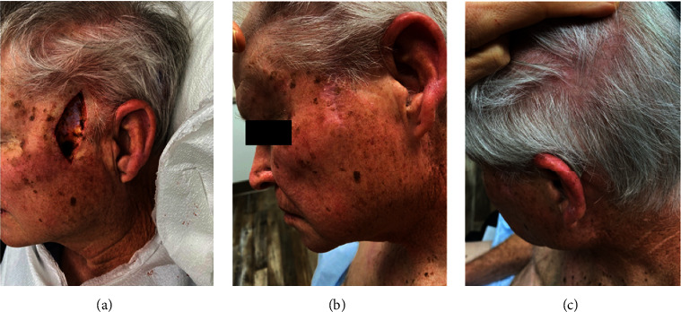 Cutaneous Neuroendocrine Metastases of Visceral Origin Responsive to Surgical Resection and Targeted Radionuclide Therapy.