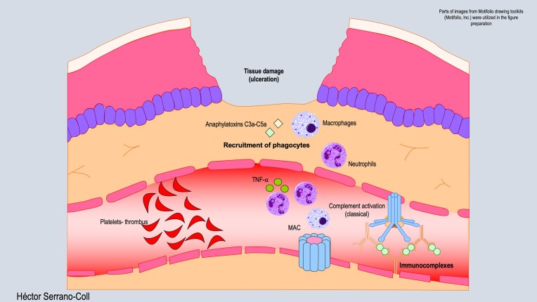Leprosy reactions: Unraveling immunological mechanisms underlying tissue damage in leprosy patients.