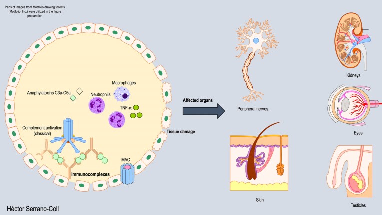 Leprosy reactions: Unraveling immunological mechanisms underlying tissue damage in leprosy patients.